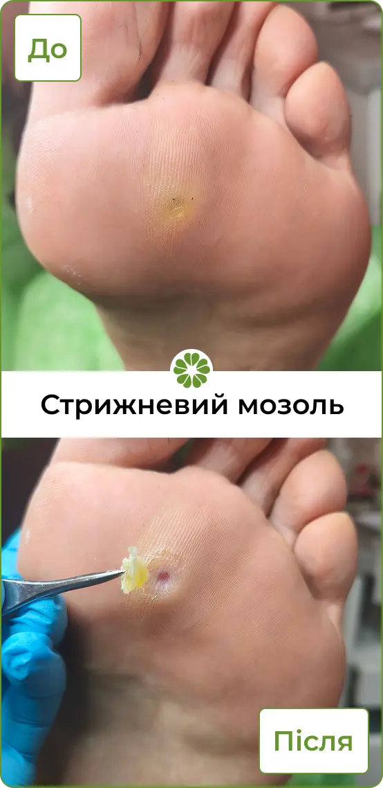 Стрижневий мозоль